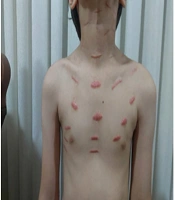Necrotizing Fasciitis Complicating Chickenpox in a Pediatric Patient: Successful Treatment with Adjunctive Use of Fresh Frozen Plasma (FFP) Plus Heparin
