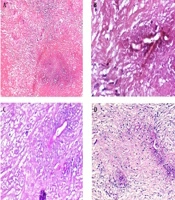 Diagnostic Challenges in Pediatric Basidiobolomycosis: A Case of Retroperitoneal Mass and Multisystem Complications