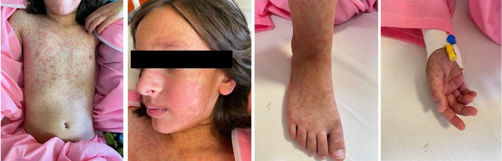 Dermatologic manifestation of the patient Dermatologic manifestation of the patient