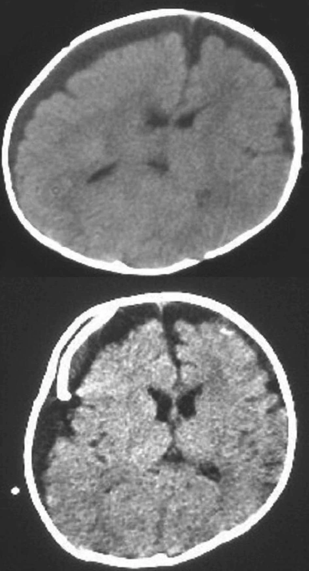 CT of Cranium CT of Cranium