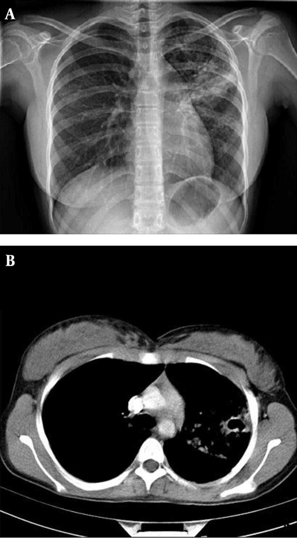 Case 6, a 14-Year-Old Female With Fever Associated With Night Sweat, Weight Loss and Cough A, Chest radiograph shows cavitary consolidation in the right lower lobe, consolidation in the right middle lobe and hydropneumothorax; B, CT scans demonstrate cavitary consolidation in the right lower lobe, hydropneumothorax, plural thickening and chest tube placed in the right hemi thorax.