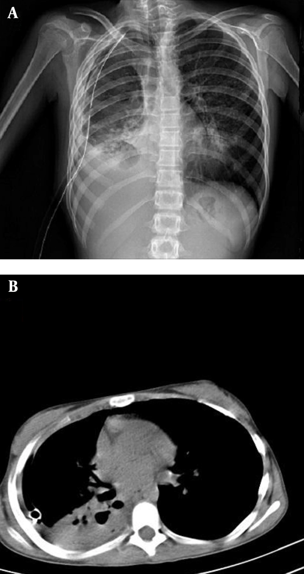 Case 7, a 14-Year-Old Female With Weight Loss and Fever A, Chest radiograph shows cavitary consolidation in the right upper lobe; B, CT scans demonstrated cavitary consolidation and multi micro nodule in the left upper lobe and left lower lobe.