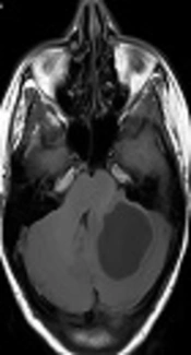 Pyogenic Brain Abscess in Children: A Tunisian Multi-Centric Experience