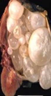 A Kidney Hydatid cyst with No Conclusive Diagnostic Radiologic Evidence: A Case Report