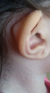 Primary Immune Deficiency or Infantile Hyaline Fibromatosis? A Case Report