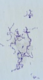 Severe Pyogenic Arthritis in a 10-Year Old Girl Due to Streptococcus dysgalactiae
