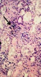 An Unusual Presentation of a Child with Hyperoxaluria