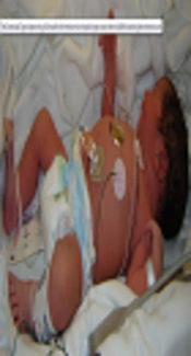 Candidemia in the Neonatal Intensive Care Unit: Insights on Epidemiology and Antifungal Drug Susceptibility Patterns