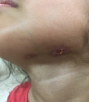 A Child with Submandibular Fistulized Mass: An Unusual Case of Salmonella typhi
