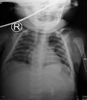 Cerebral Salt Wasting Due to Bacteremia Caused by Elizabethkingia meningoseptica: A Case Report