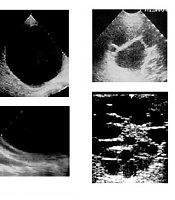 Utility of Clinical Symptoms, Serology and Ultrasonographic Findings in the Diagnose of Hydatid Cyst of the Liver in Children