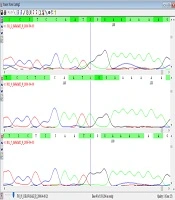 Association of 8p22-23-rs2254546 Genotypes with Coronary Artery Status and Resistance to Intravenous Immunoglobulin in Iranian Children with Kawasaki Disease