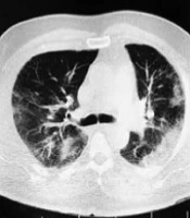 Clinical Features of ICU Admitted and Intubated Novel Corona Virus-infected Patients in Iran