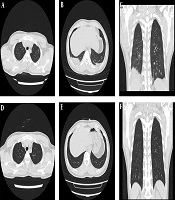 Chest CT Findings in Two Highly Suspected Cases of Coronavirus Disease 2019 (COVID-19): Avoid Overdiagnosis During Clinical Procedures