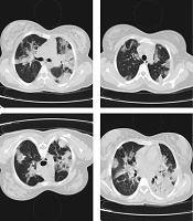 Early Intravenous Immunoglobulin as an Effective Drug for the Treatment of COVID-19: A Case Series and Case Review