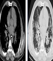 Early Computed Tomography Findings of Novel Coronavirus Disease 2019 (COVID-19) Pneumonia