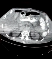 Unusual Anastomotic Failure in Patients with COVID-19: A Case Report of 2 Patients