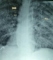 Disseminated Strongyloidiasis in Renal Transplant Recipient Complicated with Neurological Manifestations