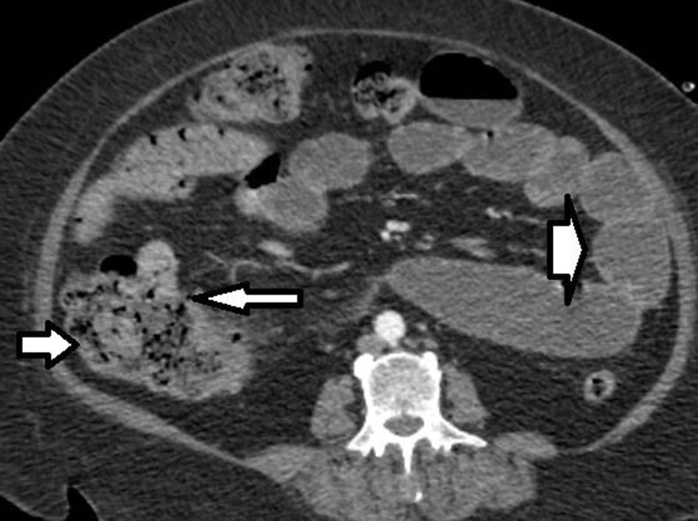 Contrast-enhanced computed tomography of the abdomen shows intestinal wall thickening and edema indicating distal obstruction (right, thick arrow), cecum (left, small arrow), and gas in the cecum wall (left, long thin arrow). Contrast-enhanced computed tomography of the abdomen shows intestinal wall thickening and edema indicating distal obstruction (right, thick arrow), cecum (left, small arrow), and gas in the cecum wall (left, long thin arrow).