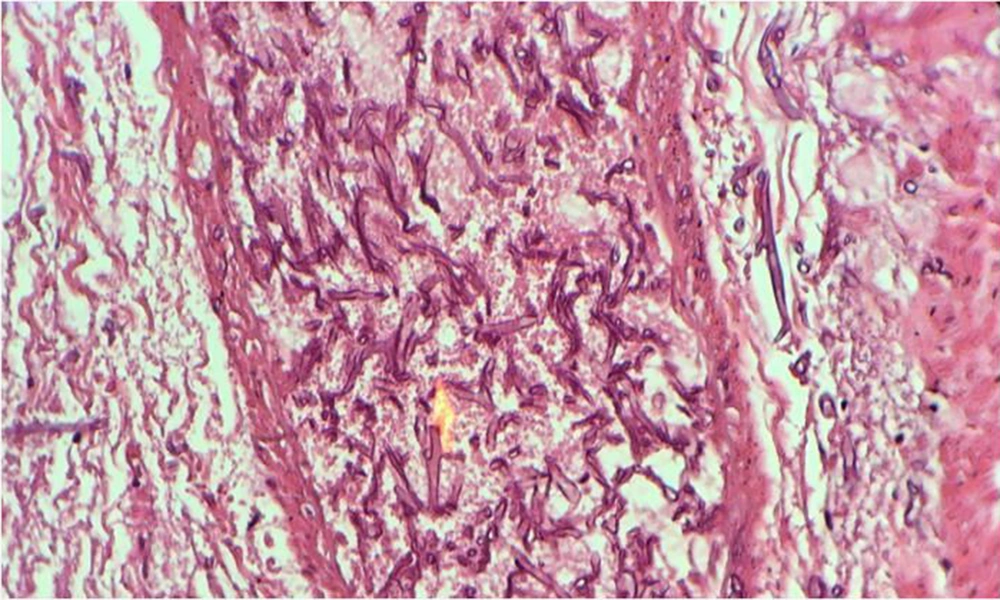 Periodic acid-Schiff (PAS) stain of cecum wall showing fungal hyphae Periodic acid-Schiff (PAS) stain of cecum wall showing fungal hyphae