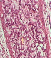 Cecum Necrosis with Terminal Ileum Perforation Due to Invasive Fungal Infection in a Patient with Diabetes Mellitus and Acute Myeloid Leukemia: A Case Report