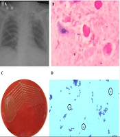 Atypical Presence of Leuconostoc pseudomesenteroides in a Lower Respiratory Tract Infection