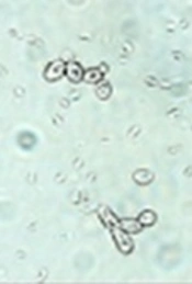 <i>In Vitro</i> Activity of Two Nanoparticles on Clinical Isolates of <i>Candida parapsilosis</i>, Showing Resistance Against Antifungal Agents in Children