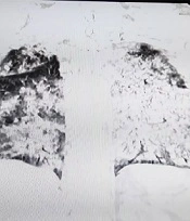 Acute Respiratory Distress Syndrome Secondary to Rabies: A Case Report and Review of the Literature