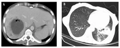 A Case Report of Disseminated Nocardiosis in a Patient with HIV Infection: Concurrent Liver, Pulmonary, and Brain Involvements