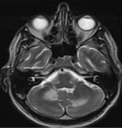 Steroid-Induced Progressive Multifocal Leukoencephalopathy (PML) in HIV Patient: A Paradoxical Effect