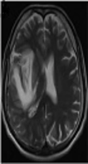 Cover image of the article: Stroke Status Developed After Herpes Viridae Infection: A Report of Two Cases