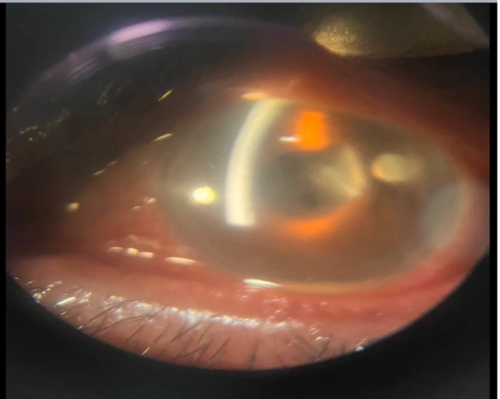 Early presentation of after intravitreal injections (IVIs) endophthalmitis Early presentation of after intravitreal injections (IVIs) endophthalmitis
