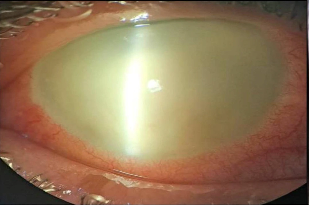 Acute presentation of after intravitreal injections (IVIs) endophthalmitis Acute presentation of after intravitreal injections (IVIs) endophthalmitis