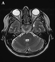 Behçet's Disease Manifesting as Panhypopituitarism Due to a Compressive Aspergillus Granuloma Adjacent to the Pituitary Gland: A Case Report