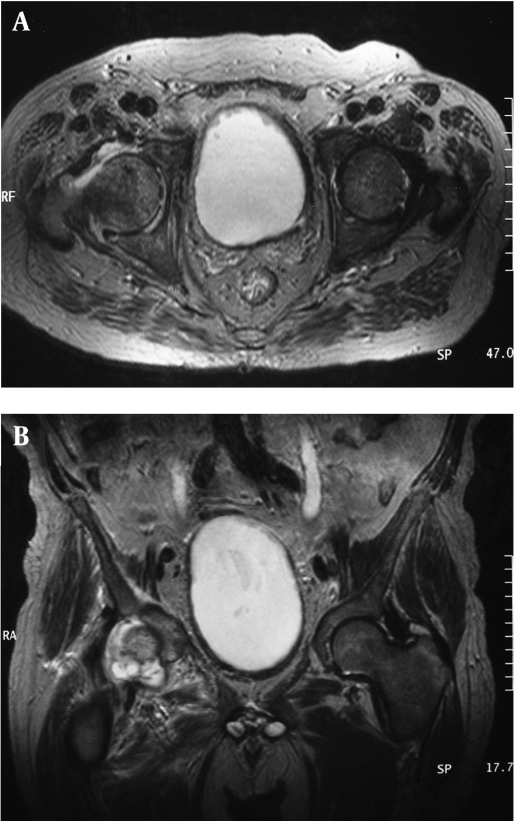 Hip Magnetic Resonance Imaging (MRI) Shows Long T1 Signal in Bladder, Ureter and Left Hip, Suggesting Simultaneous Bladder Abscess and Left Hip Arthritis Hip Magnetic Resonance Imaging (MRI) Shows Long T1 Signal in Bladder, Ureter and Left Hip, Suggesting Simultaneous Bladder Abscess and Left Hip Arthritis