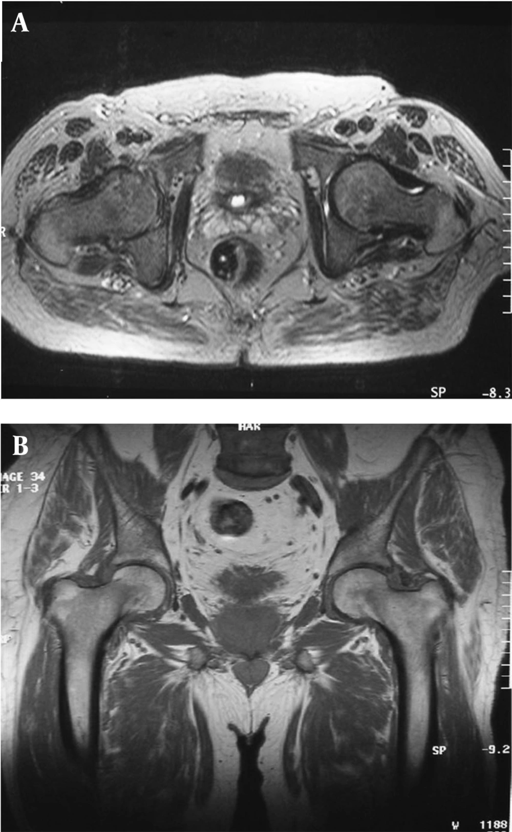 Hip Magnetic Resonance Imaging (MRI) Shows Regression of Hip Arthritis After Draining of Bladder Abscess Hip Magnetic Resonance Imaging (MRI) Shows Regression of Hip Arthritis After Draining of Bladder Abscess