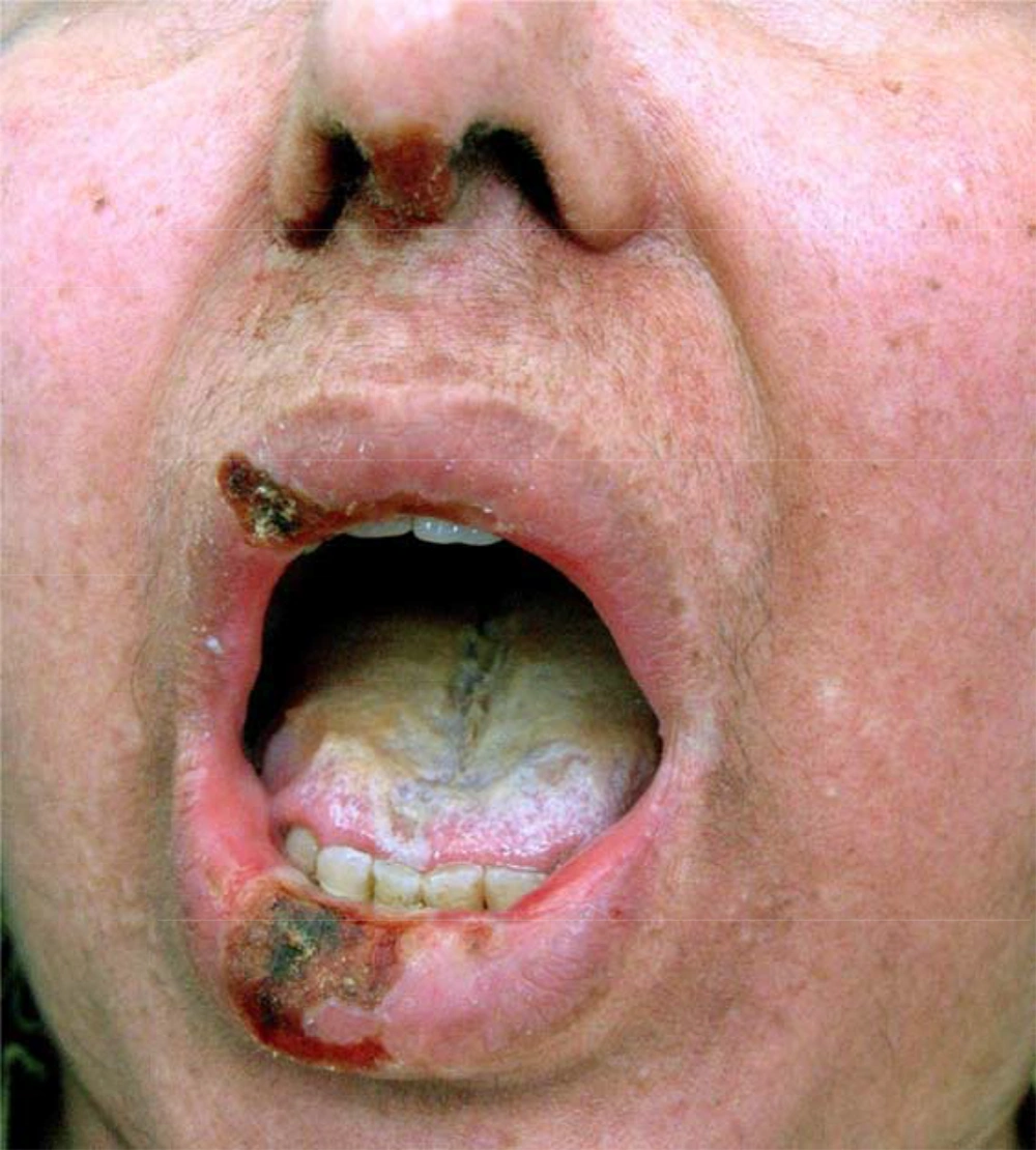 Ulcerative Lesions on Upper and Lower Lip and on Nose Admixed With Central Crusts and Necrosis Ulcerative Lesions on Upper and Lower Lip and on Nose Admixed With Central Crusts and Necrosis