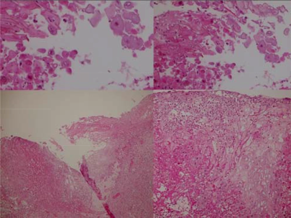 Histopathology of Lesions Histopathology of Lesions
