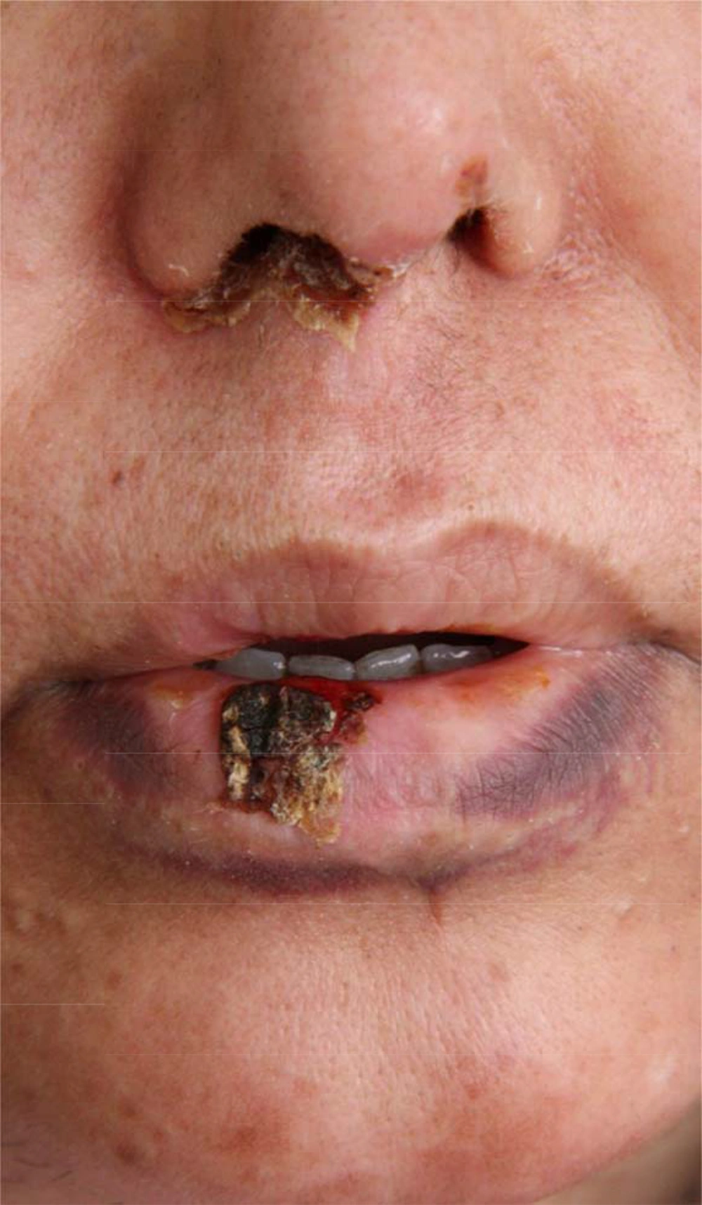 One week after Treatment With Acyclovir Therapy, the Lesions Markedly Improved One week after Treatment With Acyclovir Therapy, the Lesions Markedly Improved