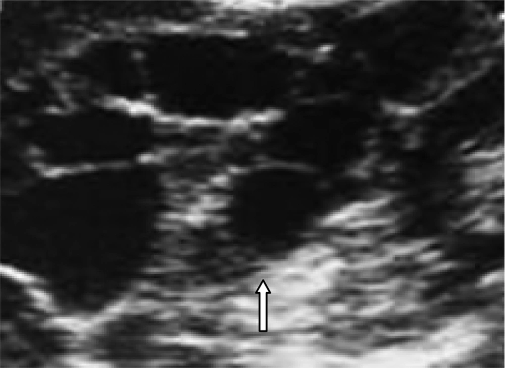 Ultrasound of the Upper Abdomen Demonstrating a Splenic Hydatid Cyst With Multiloculated Appearance Ultrasound of the Upper Abdomen Demonstrating a Splenic Hydatid Cyst With Multiloculated Appearance
