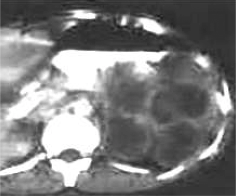 Abdominal CT Shows a Well-defined Cystic Mass With Multiloculated Appearance and No Evidence of Calcification Abdominal CT Shows a Well-defined Cystic Mass With Multiloculated Appearance and No Evidence of Calcification