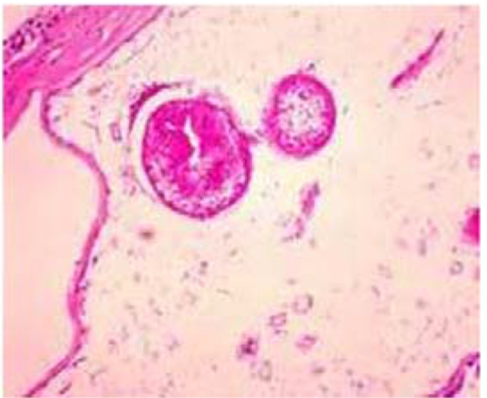 Pathological Specimen Confirmed the Hydatid Cyst Pathological Specimen Confirmed the Hydatid Cyst