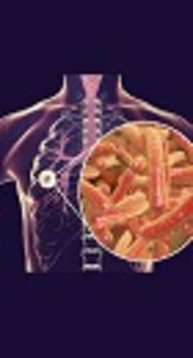 Secondary Attack Rate (SAR) of Tuberculosis in Hamedan Province, 2005 - 2013