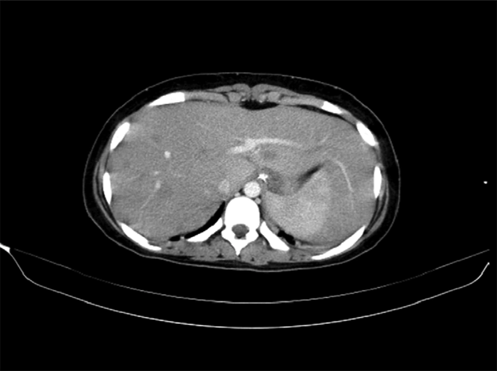 Abdominal CT-Scan Multiple Hypodense Liver Lesions Abdominal CT-Scan Multiple Hypodense Liver Lesions