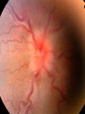 A Rare Case Series of Intraorbital Unilocular Hydatid Cysts in Pediatric Patients