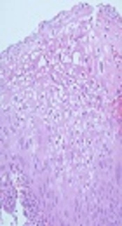 Misdiagnosis of Primary Urethral Condyloma Acuminata with Papillary Cancer: A Case Report