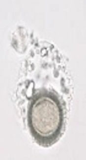 The Human Invasive Cysticercosis by Atypical <i>Taenia</i> Species
