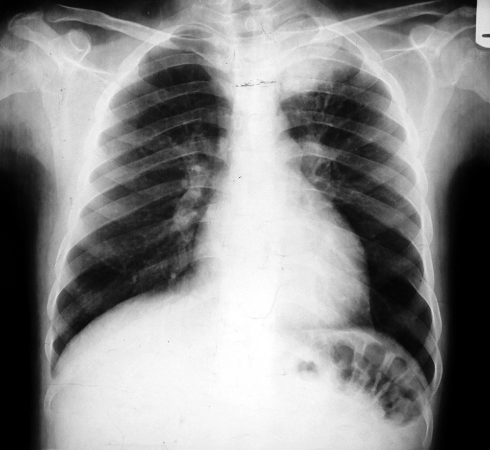 Patient’s Pre-Operation Chest X-Ray Showing a Mass at the Top of the Left Lung Patient’s Pre-Operation Chest X-Ray Showing a Mass at the Top of the Left Lung