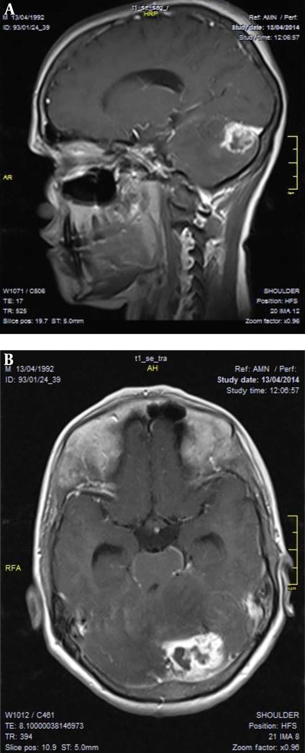 Sagittal (A) and Axial (B) Preoperative MRI of the Patient Showing a Space-Occupying Lesion in the Posterior Fossa Sagittal (A) and Axial (B) Preoperative MRI of the Patient Showing a Space-Occupying Lesion in the Posterior Fossa