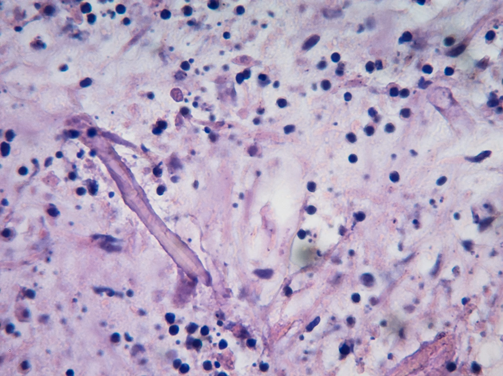 Histopathologic Section of the Specimen, Revealing the Diagnosis of Mucormycosis (100×) Histopathologic Section of the Specimen, Revealing the Diagnosis of Mucormycosis (100×)